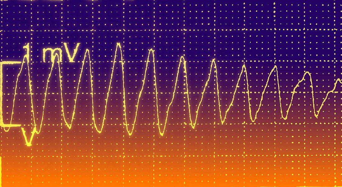 ECG trace of a heart attack