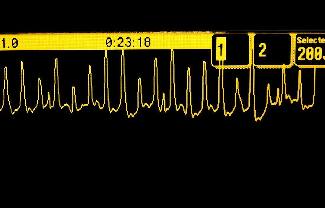 ECG trace of a heart attack