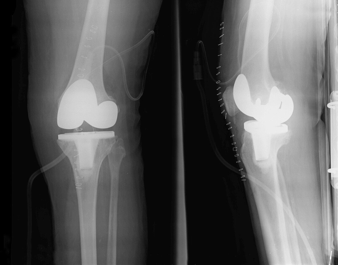 Knee joint replacement,X-ray