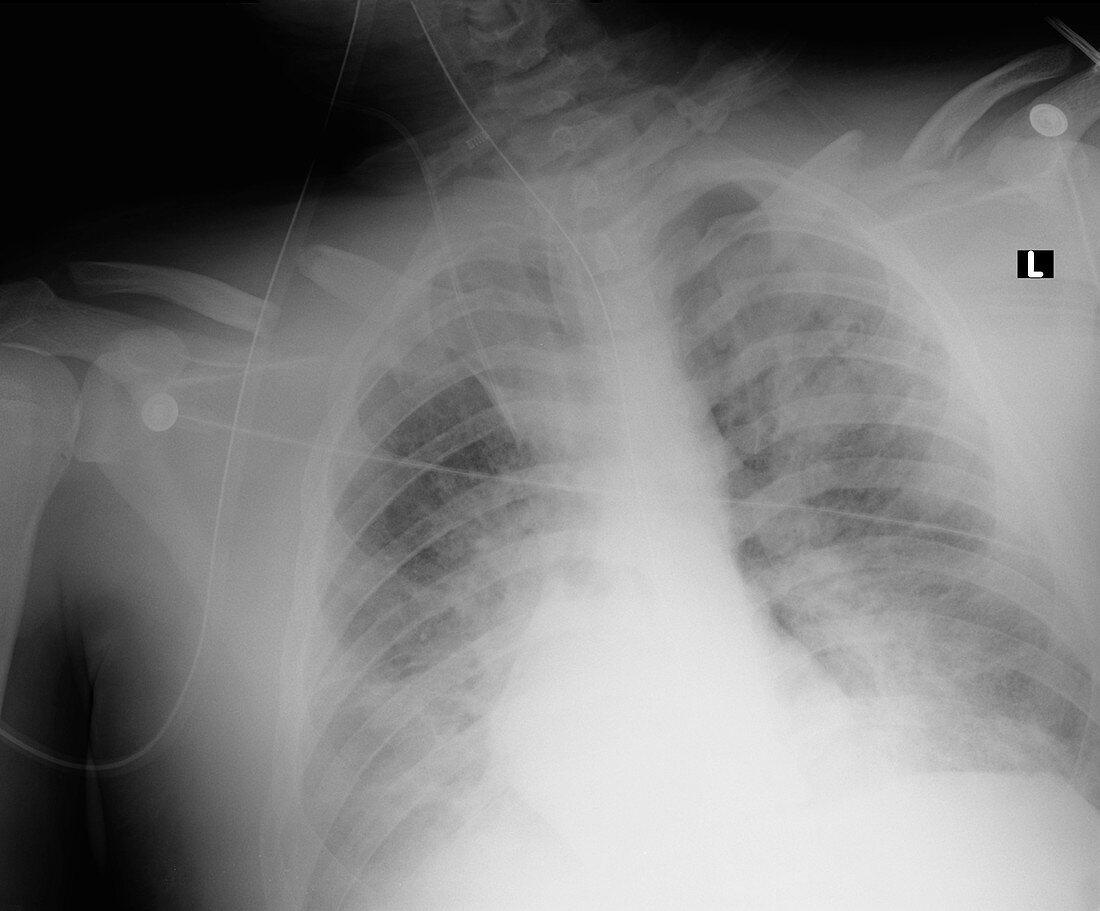Respiratory distress syndrome,X-ray