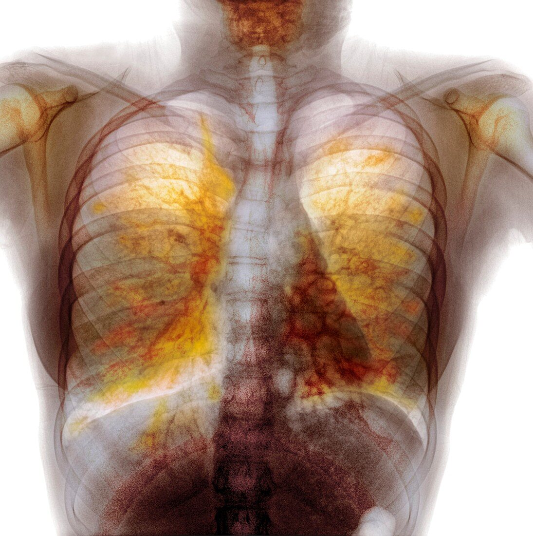 Cystic fibrosis,X-ray