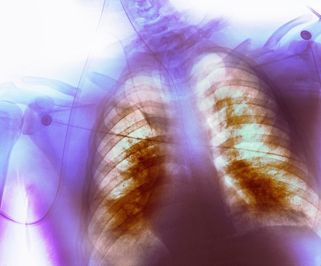 Respiratory distress syndrome,X-ray