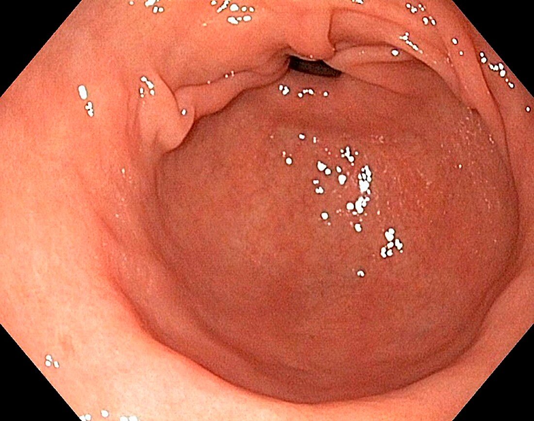 Healthy antrum of the stomach