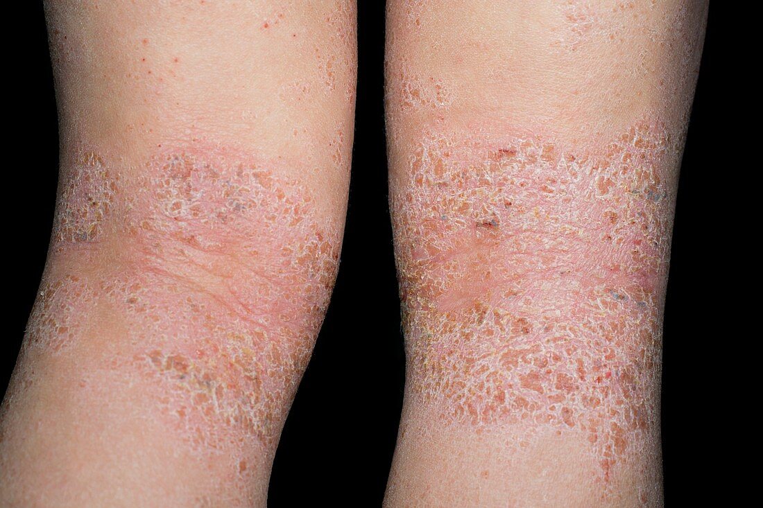 Atopic dermatitis behind the knees