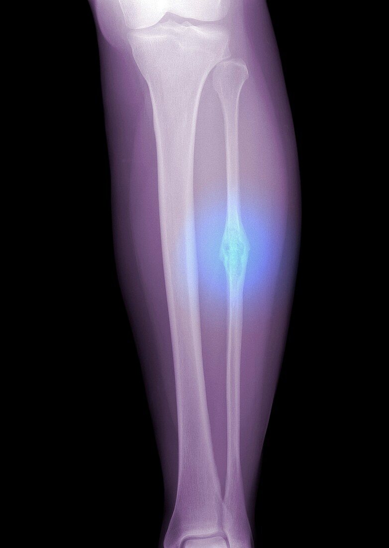 Bone cancer,X-ray