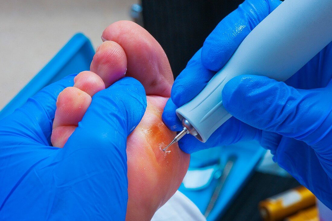 Podiatric treatment for corn on a foot