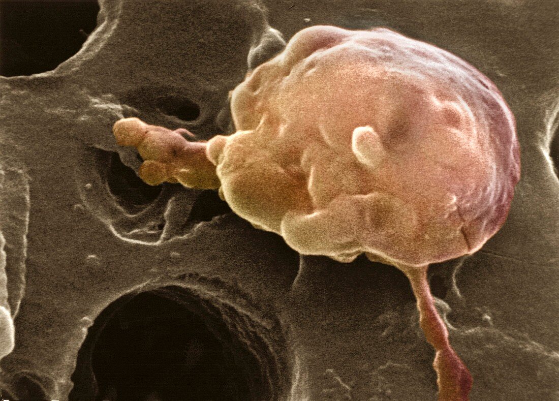 Cancer cell attacked by macrophages,SEM