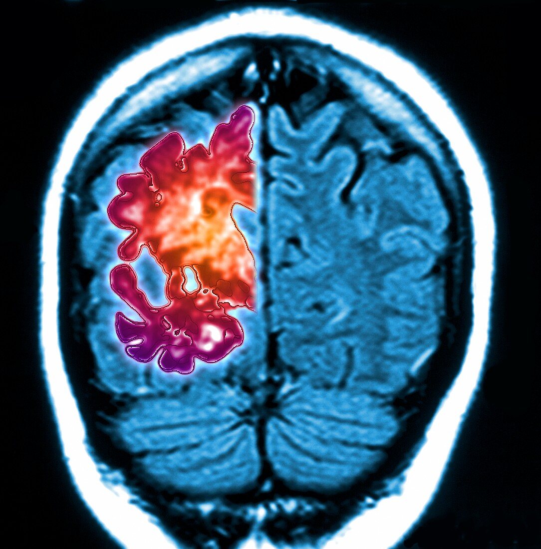 Alzheimer's brain,composite image