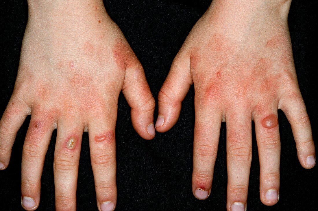 Streptococcal rash on the hands