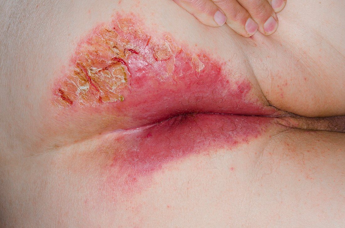 Dermatitis around the anus