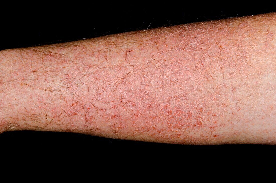 Photosensitive rash on the arm