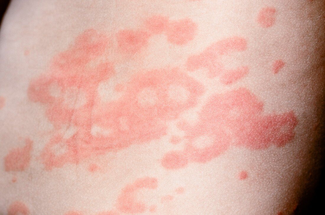 Urticaria rash on the skin