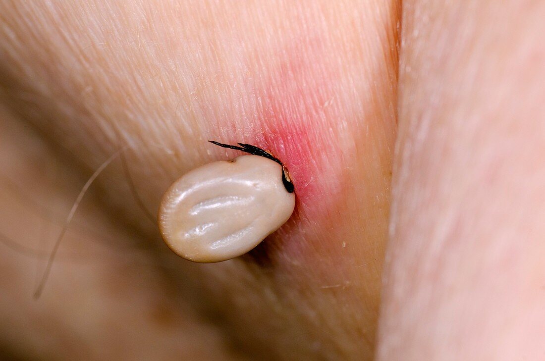 Tick biting the skin