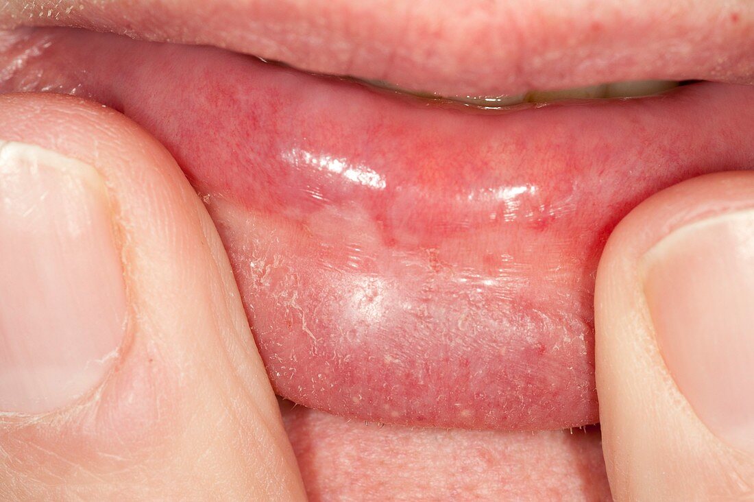 Leukoplakia on the lower lip
