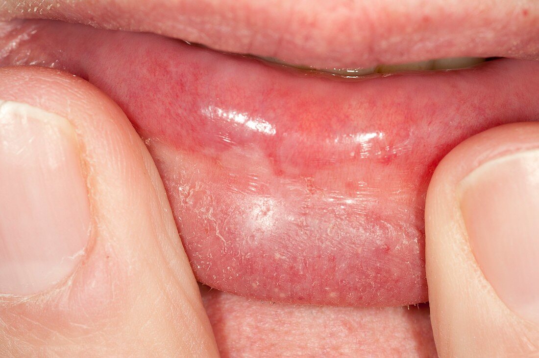 Leukoplakia On The Lower Lip Acheter Une Photo 11626993 Science