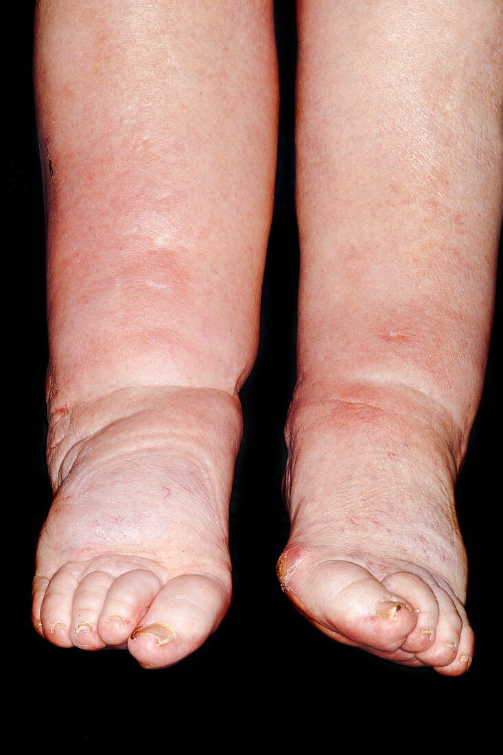 Oedema of the lower limbs
