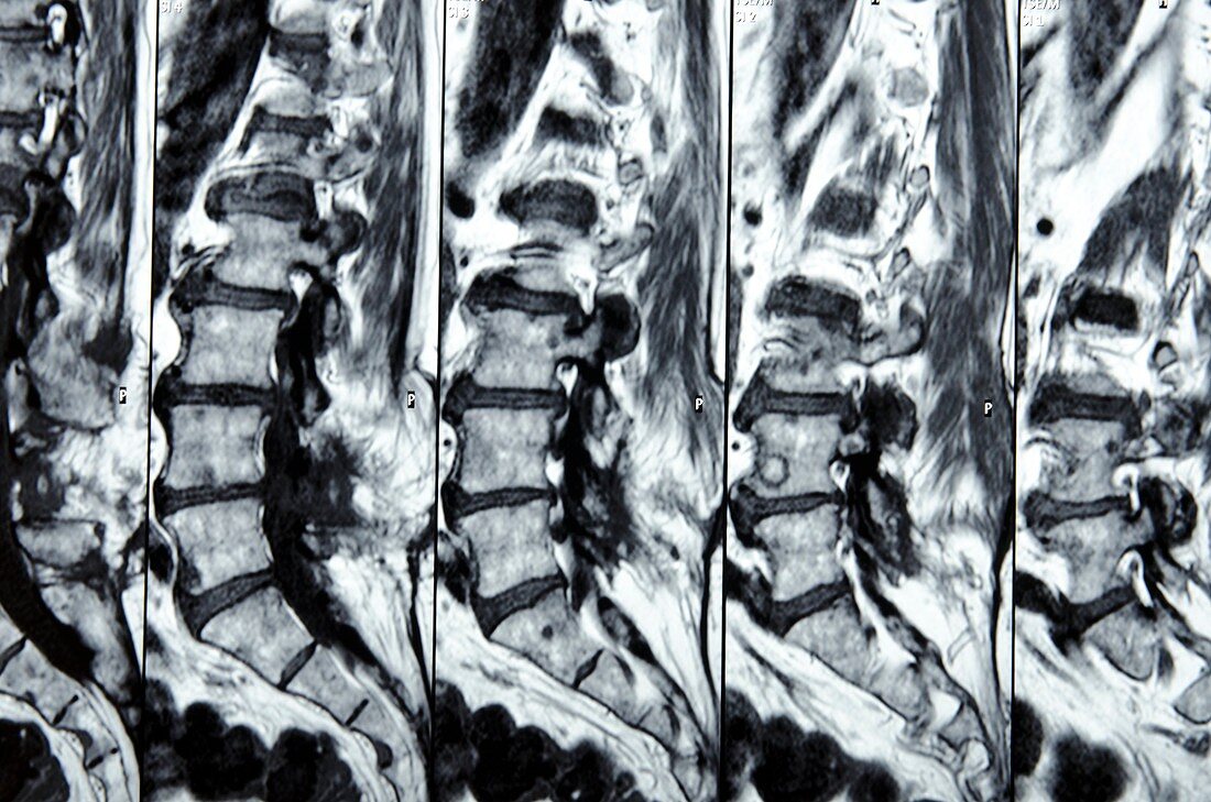MRI scans of the spine