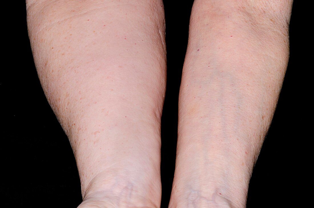 Secondary lymphoedema in the arm