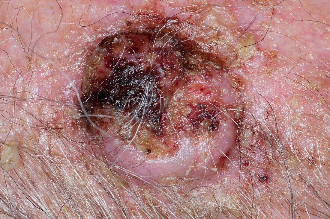 Squamous cell cancer on the scalp