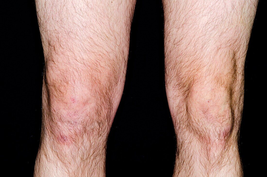 Effusion of knee from sport's injury
