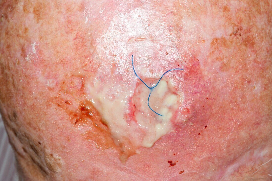 Wound after skin cancer removal