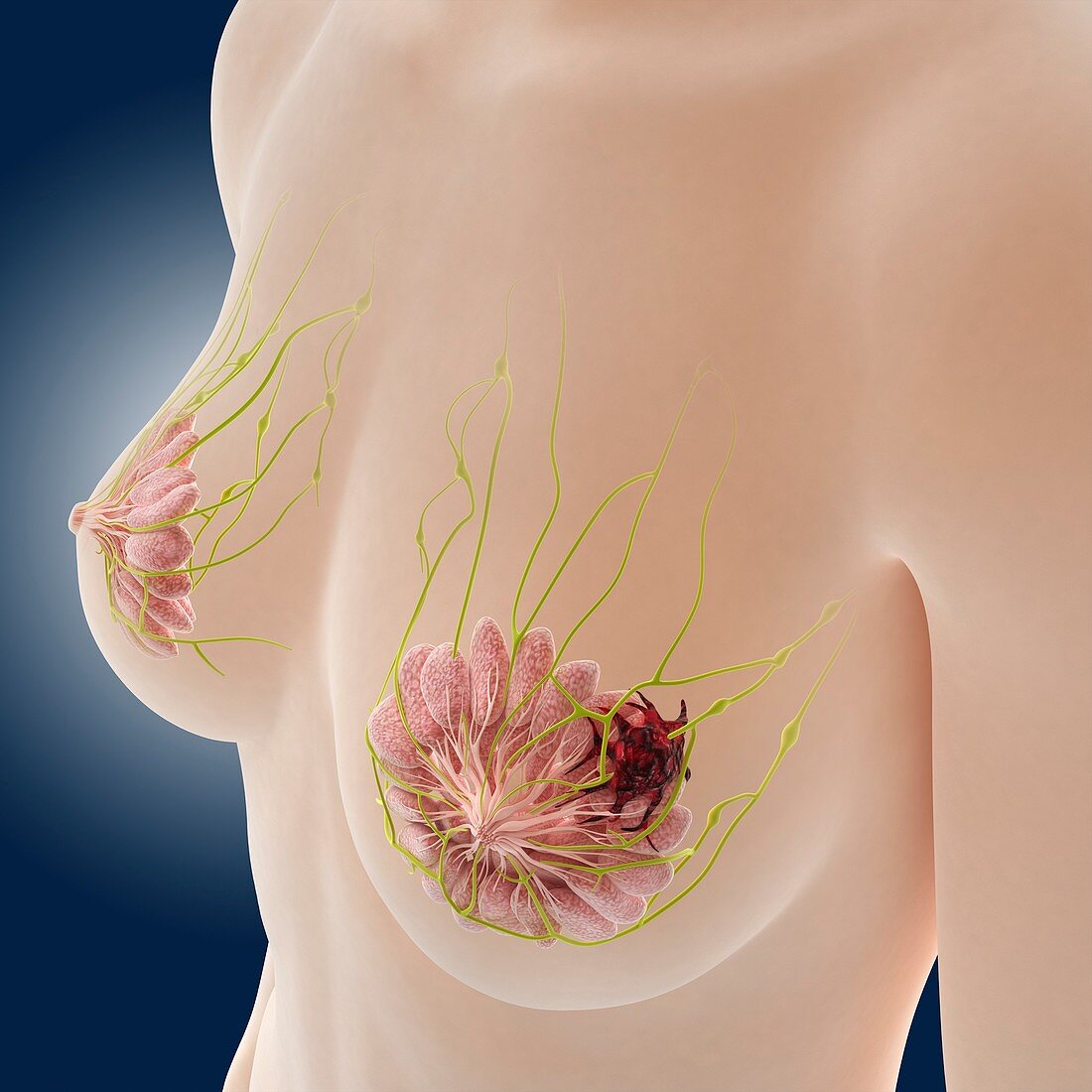 Breast cancer,artwork