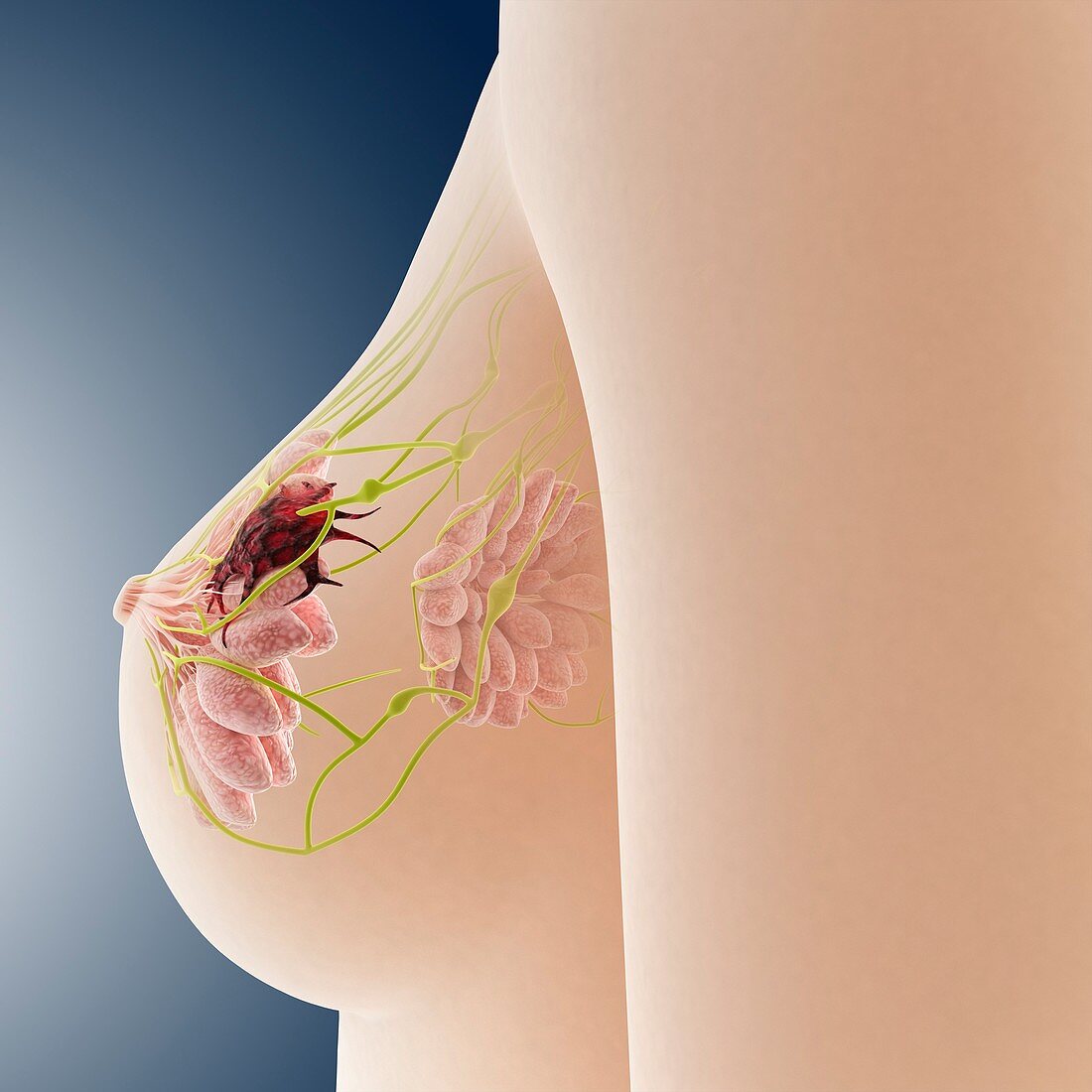 Breast cancer,artwork