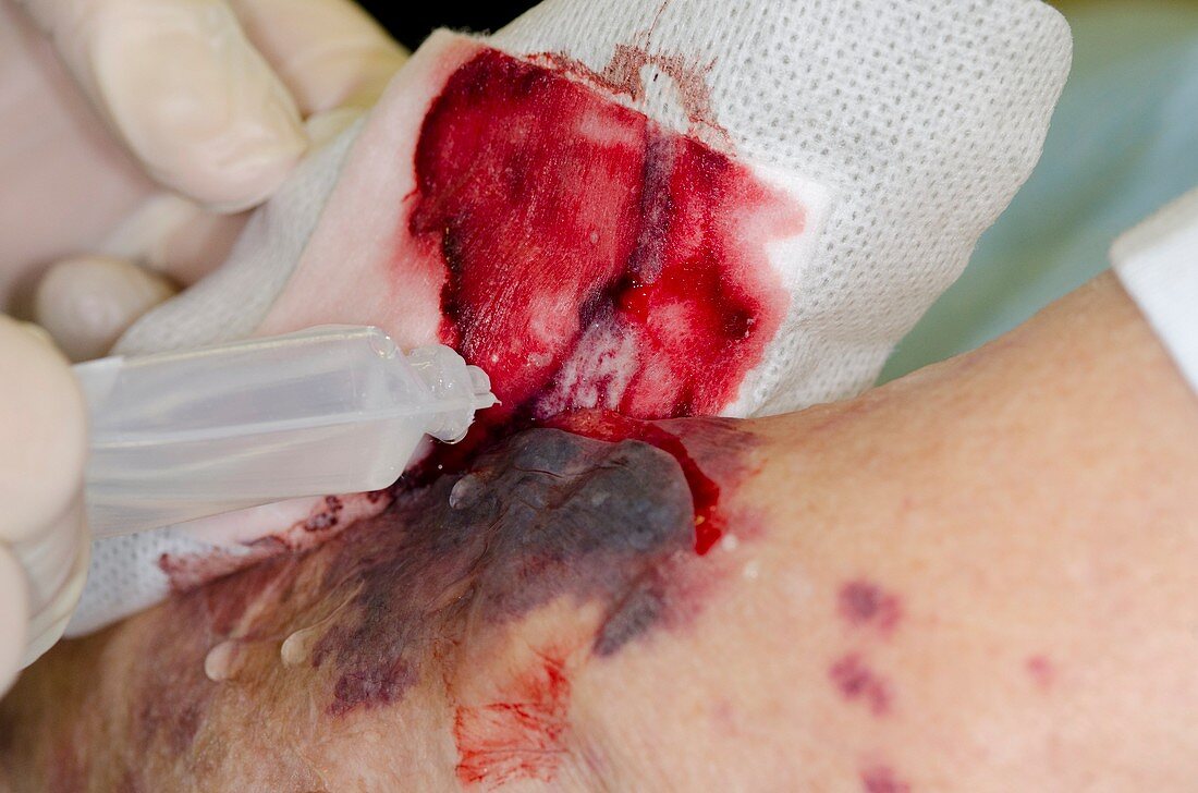 Treating a flap laceration