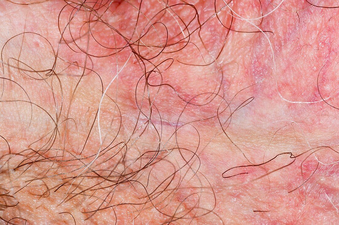 Vasectomy scars