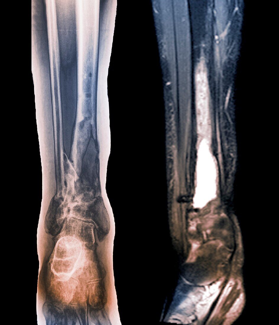 Damaged tibia,X-ray and MRI