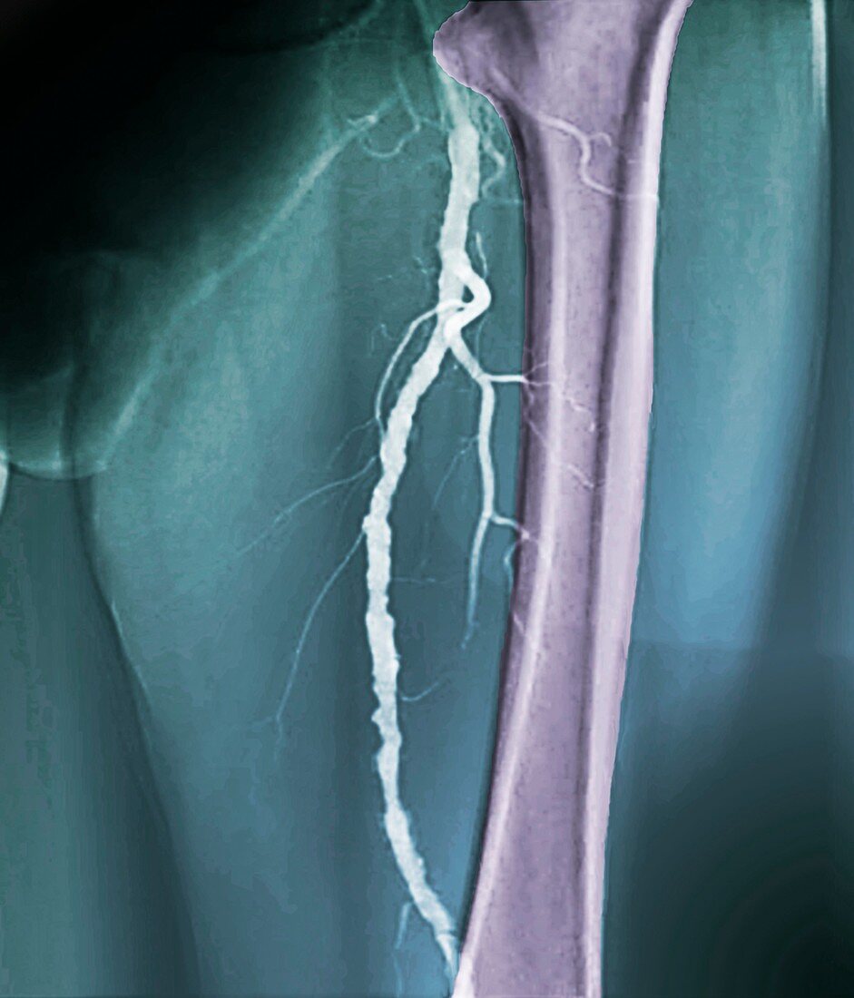 Atherosclerosis,X-ray