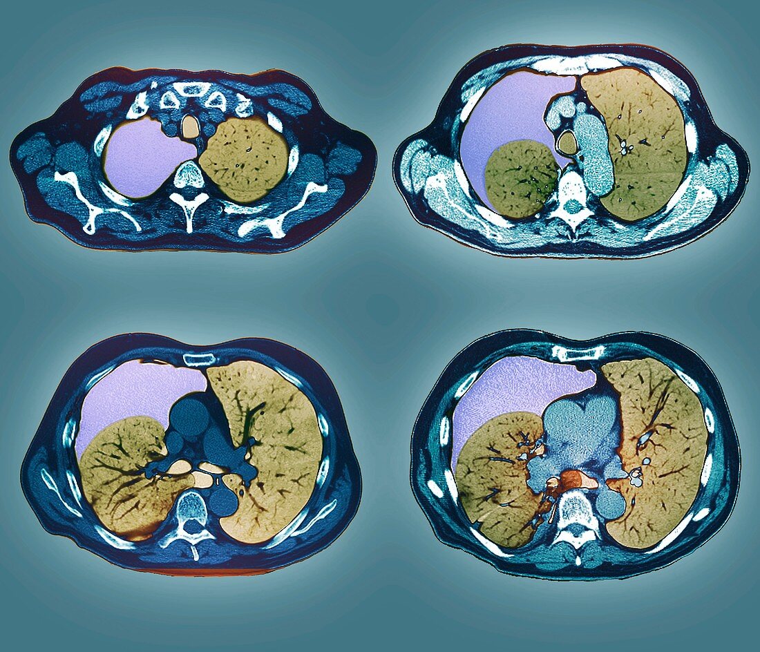 Pneumothorax,CT scan