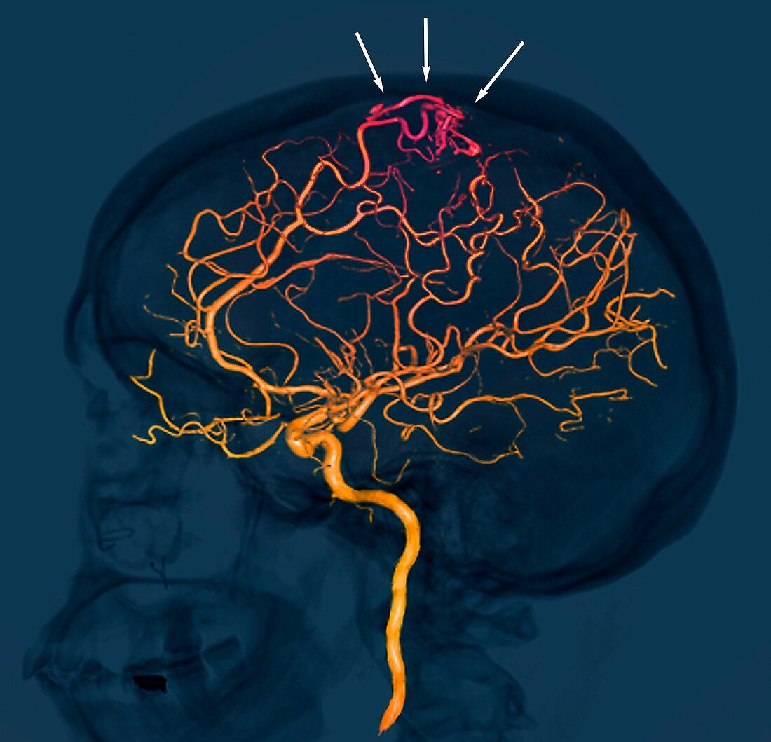 Brain vascular abnormality,3D CT scan