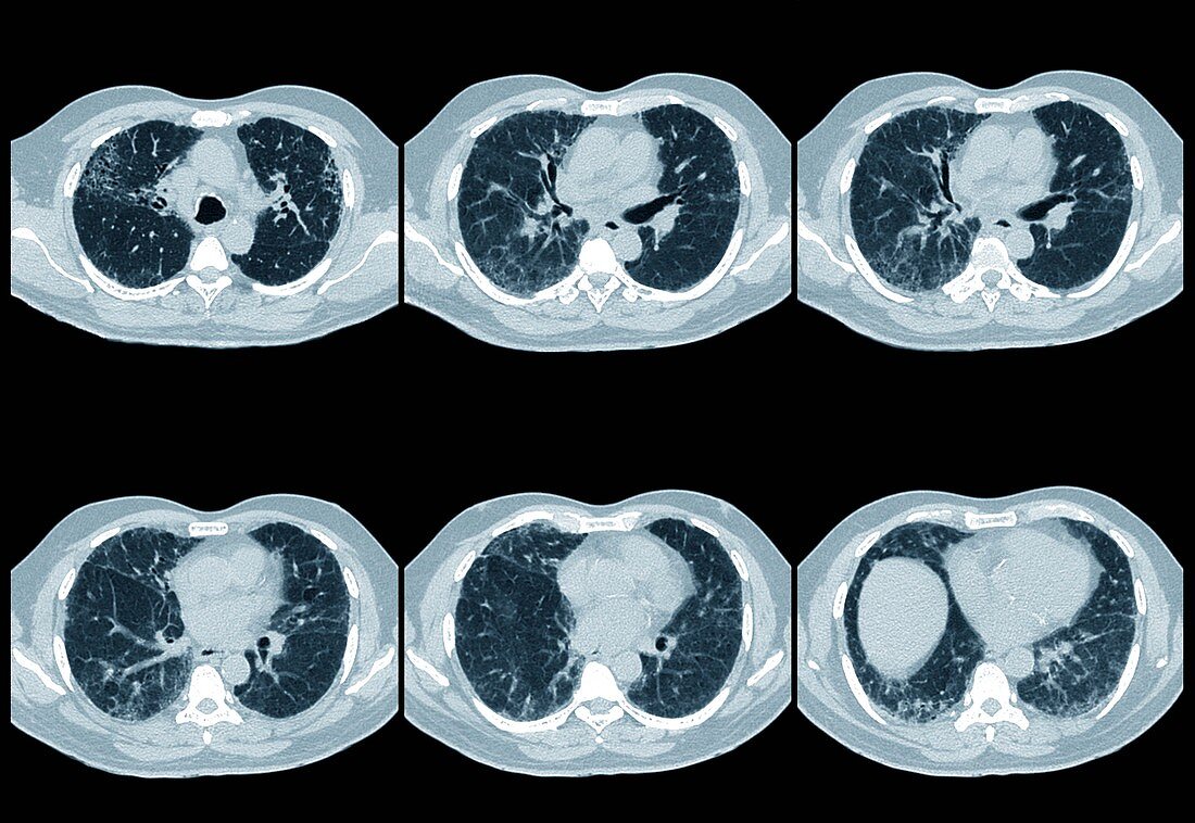 Interstitial lung disease,CT scan