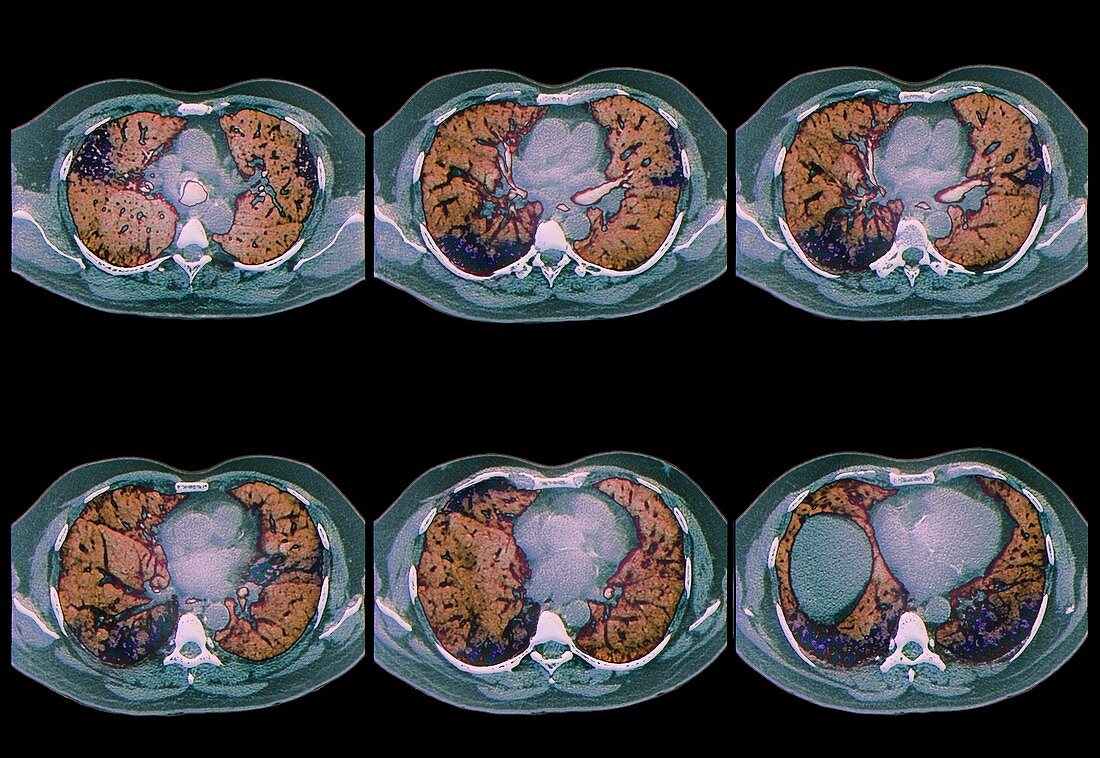 Interstitial lung disease,CT scan