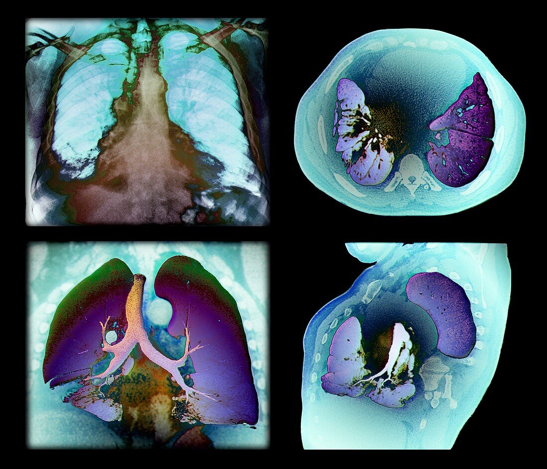 Kaposi's sarcoma of the lung,CT scans