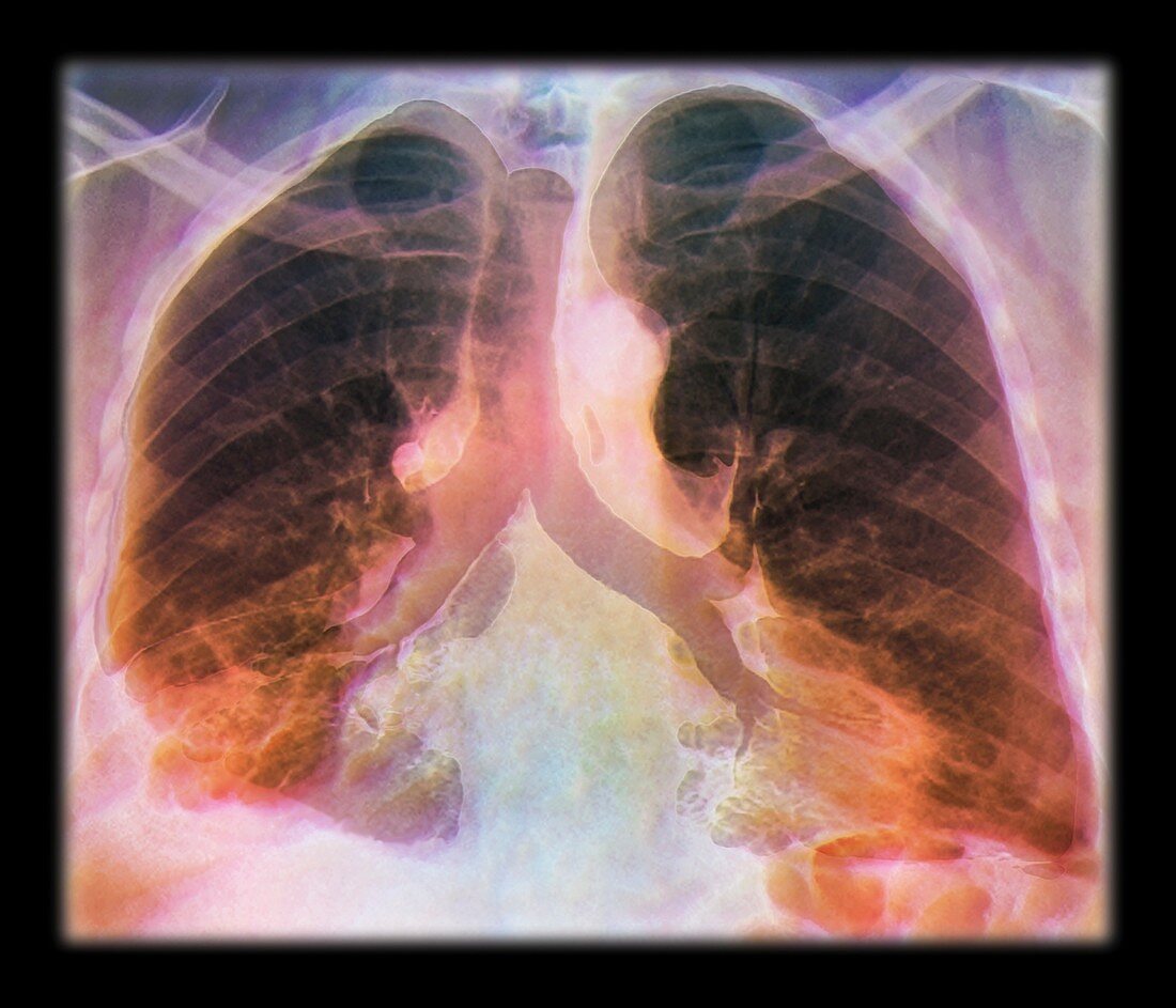 Kaposi's sarcoma of the lung,CT scan