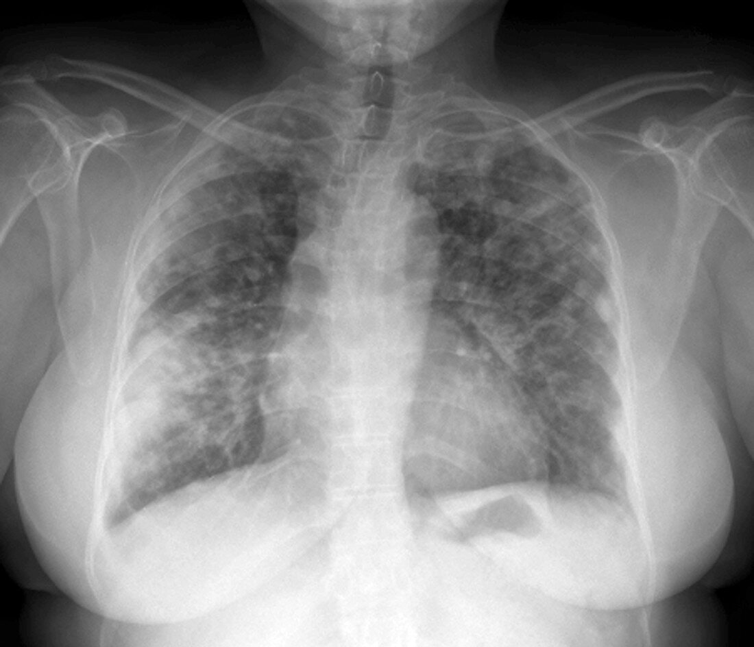 Lung disease,chest X-ray