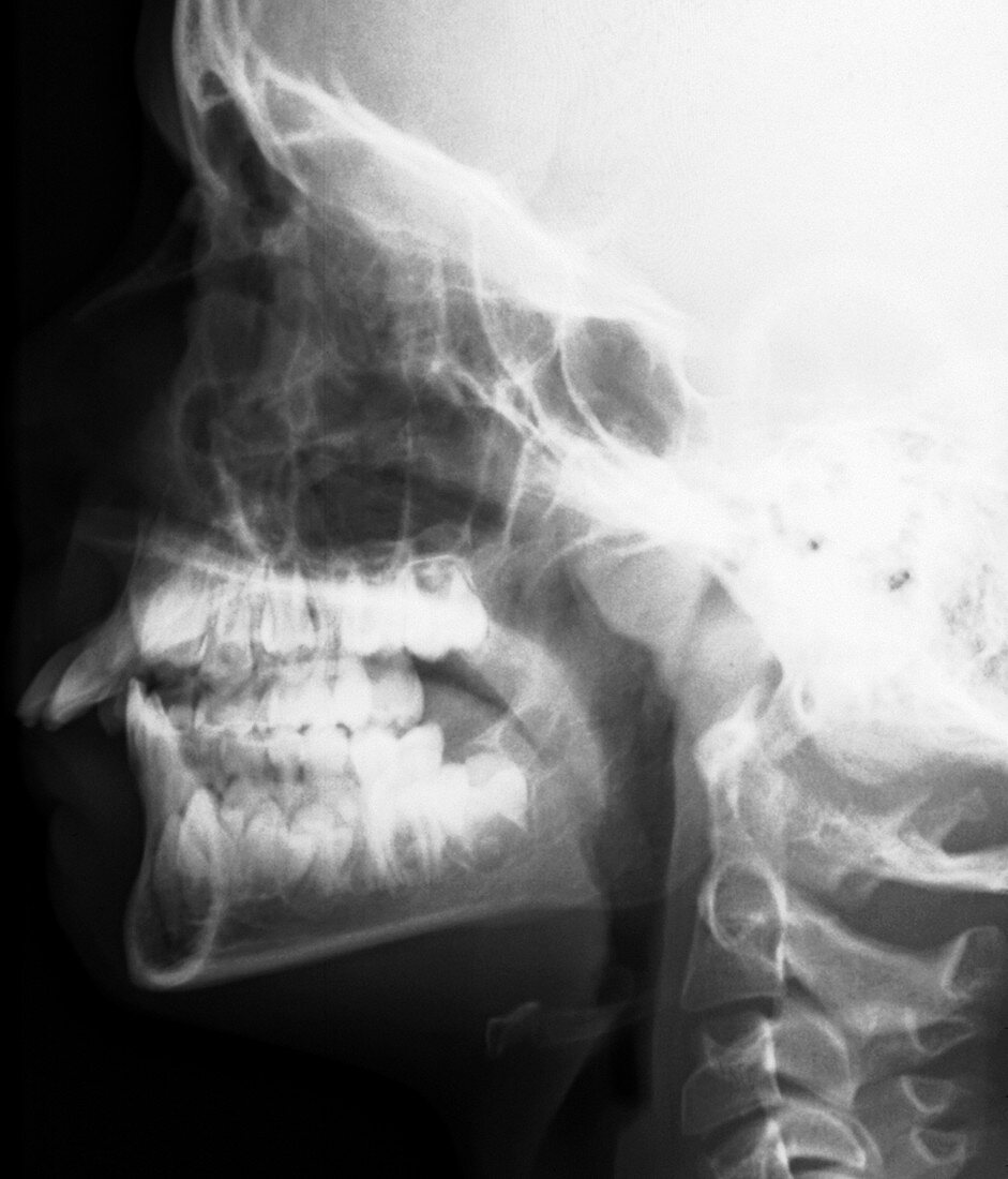 Adenoid hypertrophy in a child,X-ray
