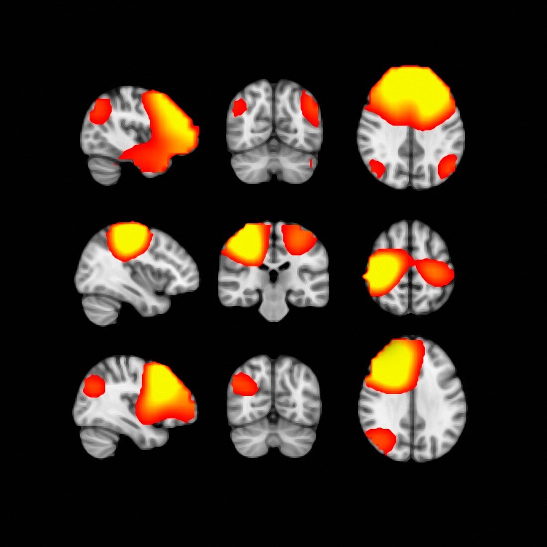 MEG brain scans