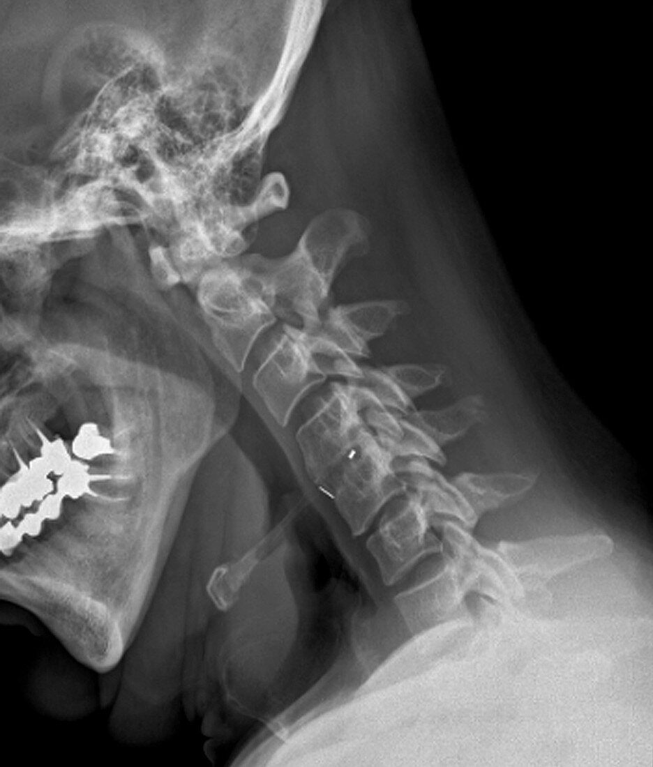 Spine fixation,X-ray