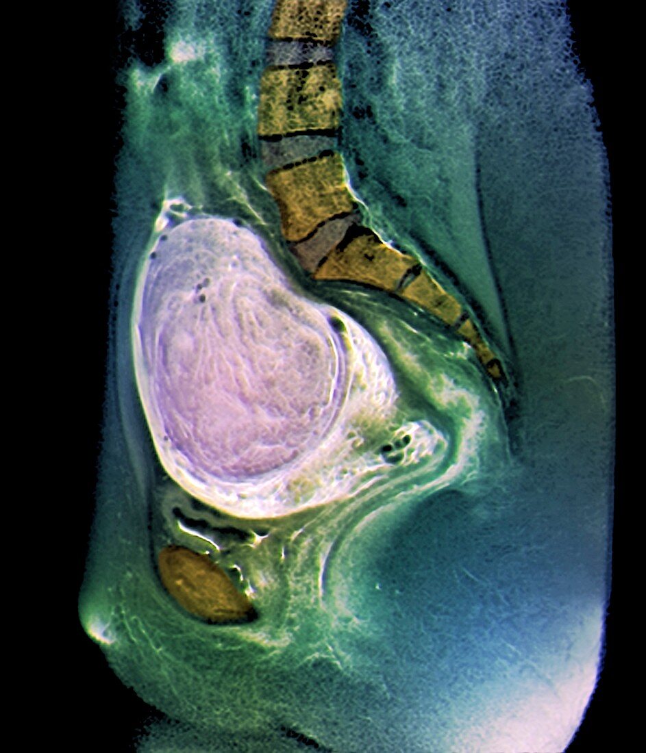Uterine fibroid,X-ray