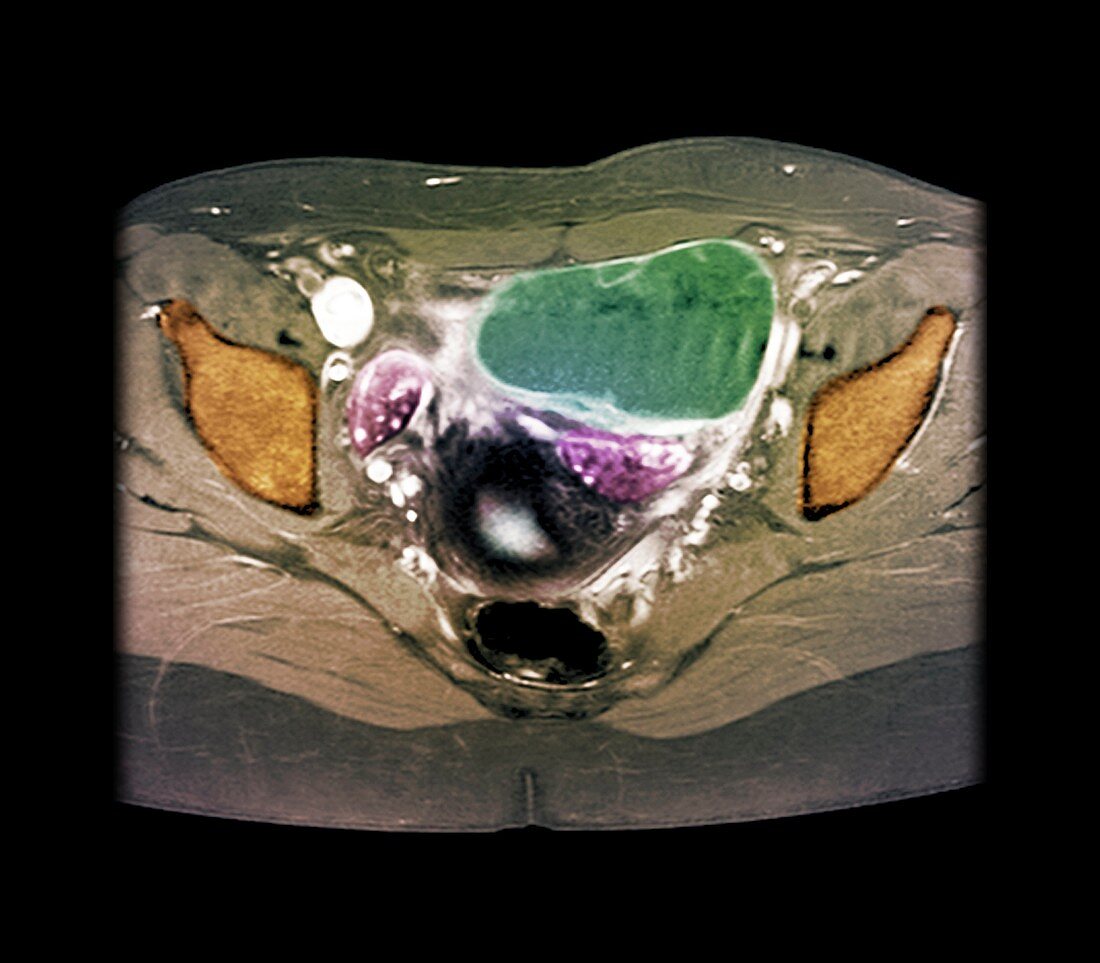 Ovarian cyst,X-ray
