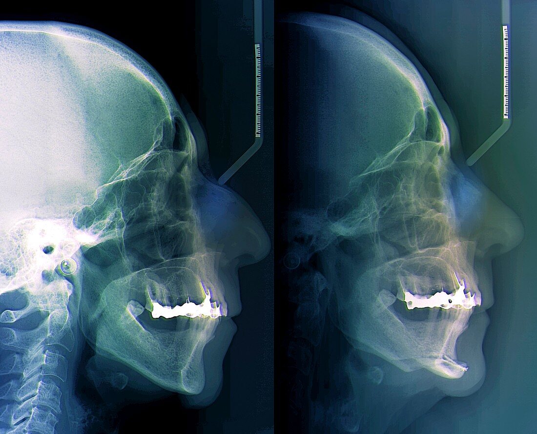 Facial plastic surgery,X-ray