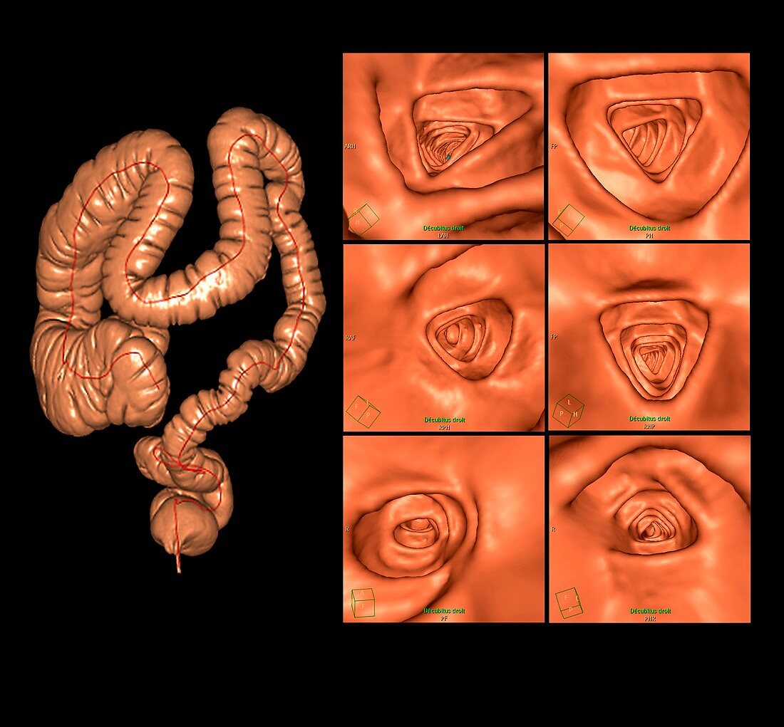 Healthy large intestine,CT scans