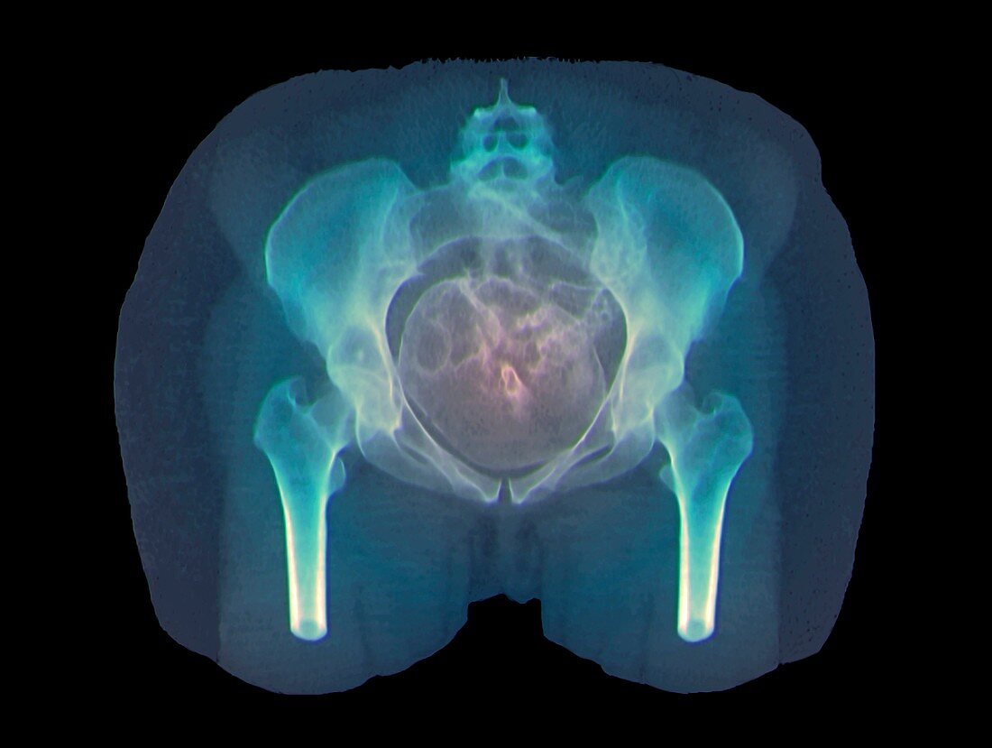 Full-term foetus,CT scan