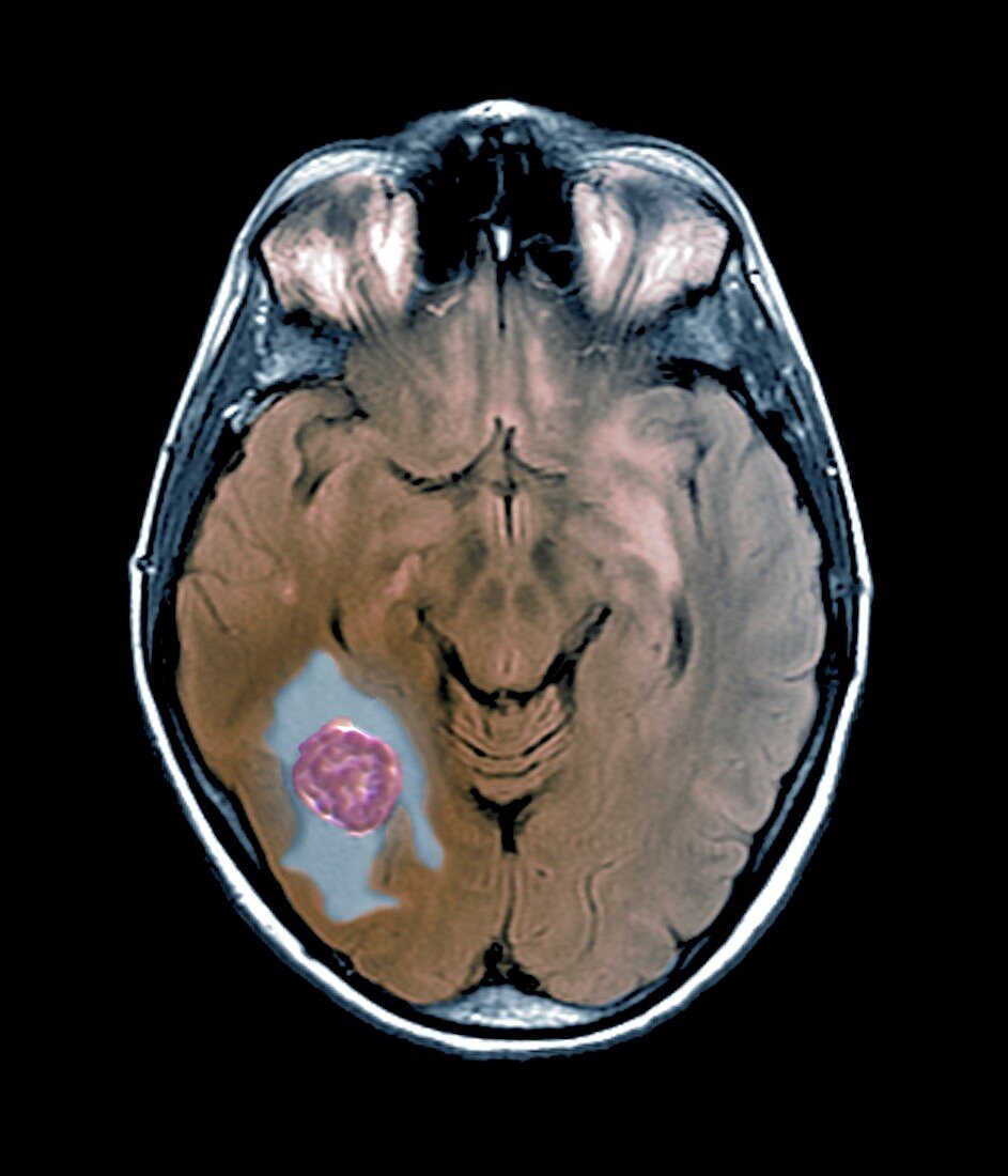 Brain cancer,MRI scan