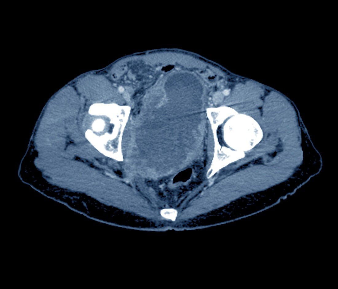 Bladder cancer,MRI scan