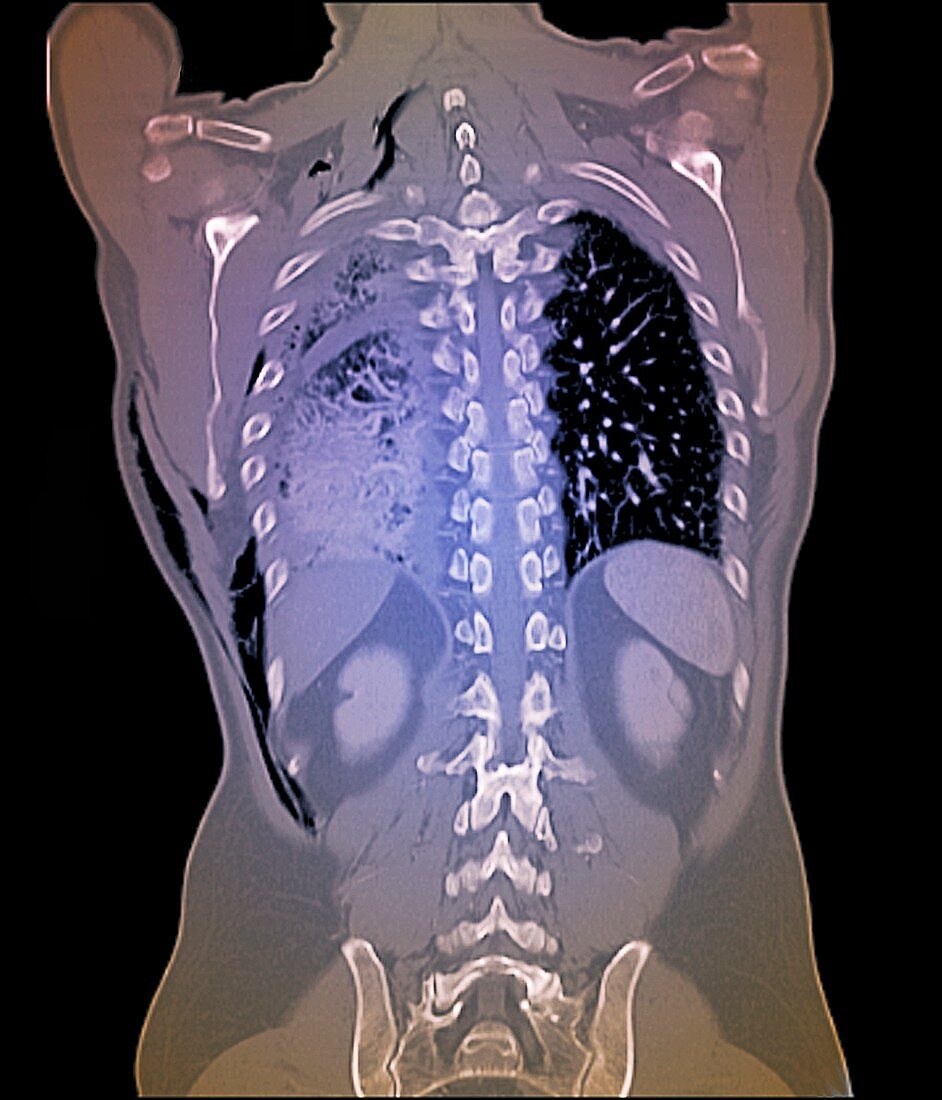 Haemopneumothorax,CT scan