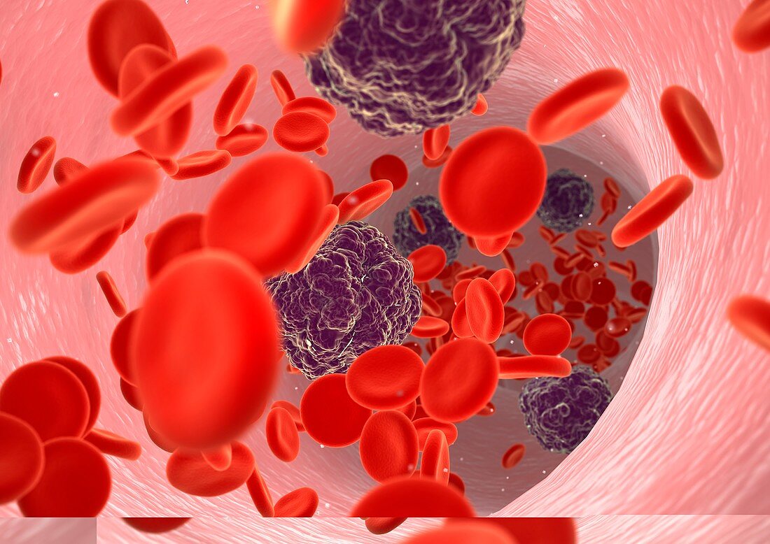 Blood cancer,conceptual image